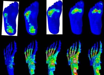بررسی انگشتان پای دیابتی ها برای طراحی کفش و کفی طبی